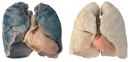 The smoker's lungs (blackened) and heart (enlarged) are the ones on the left, obviously.